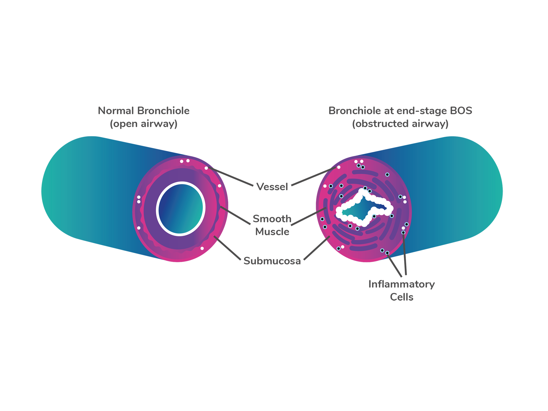 Normal Bronchiole (Open Airway) and End-Stage BOS Bronchiole (Obstructed Airway)